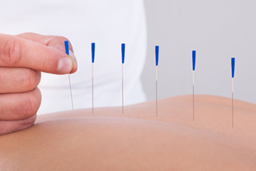 Dry-Needling-1-360x240